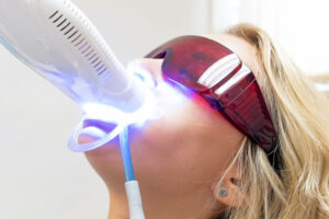 Hydrogen Peroxide Teeth Whitening