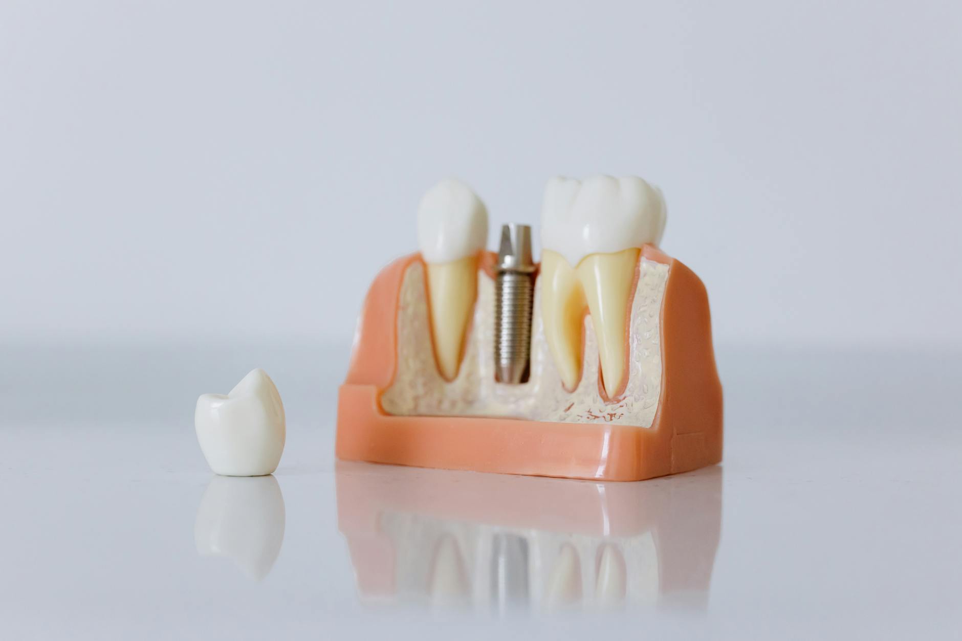 Close-up of a dental implant model featuring artificial teeth and jaw structure. — Atrium Scientific Group